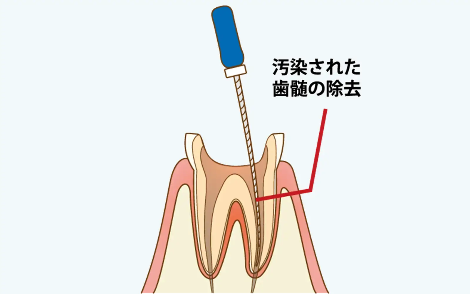 ステップ1：感染の除去(機械的清掃)