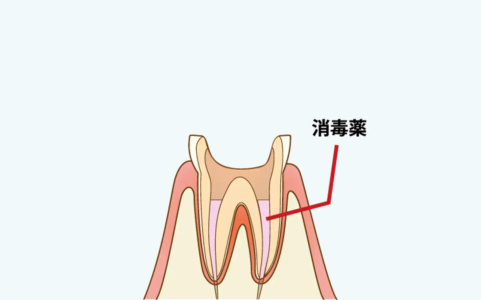 ステップ2：化学的消毒(灌注)