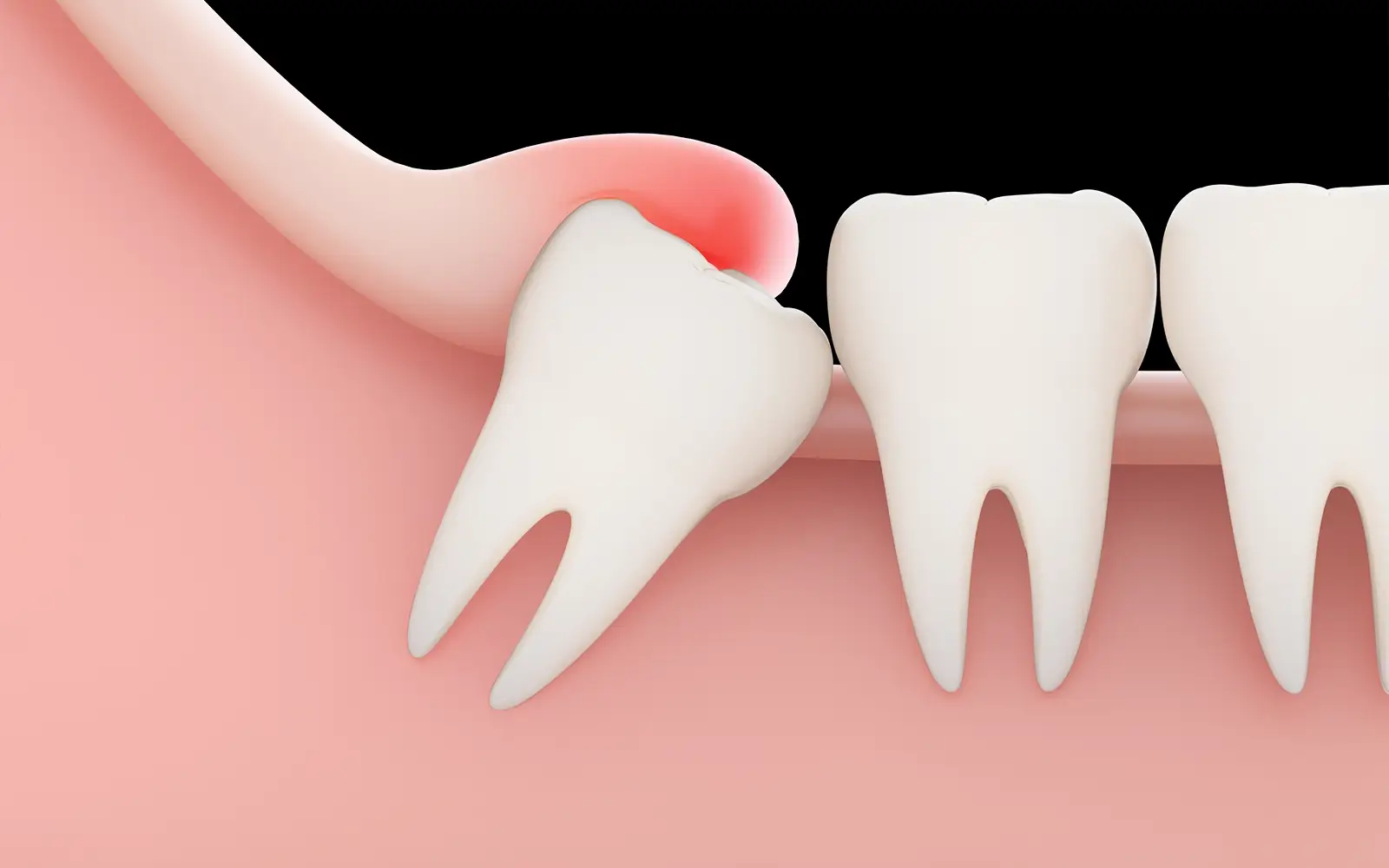 智歯周囲炎(pericoronitis)
